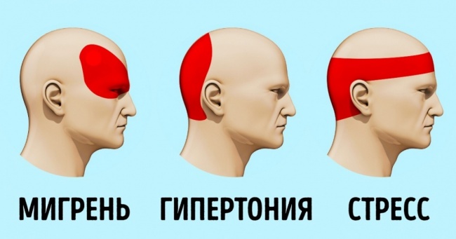 мигрень гипертония стресс
