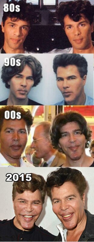 Bogdanoff Twins - Downward spiral of Dysmorphic Disorder