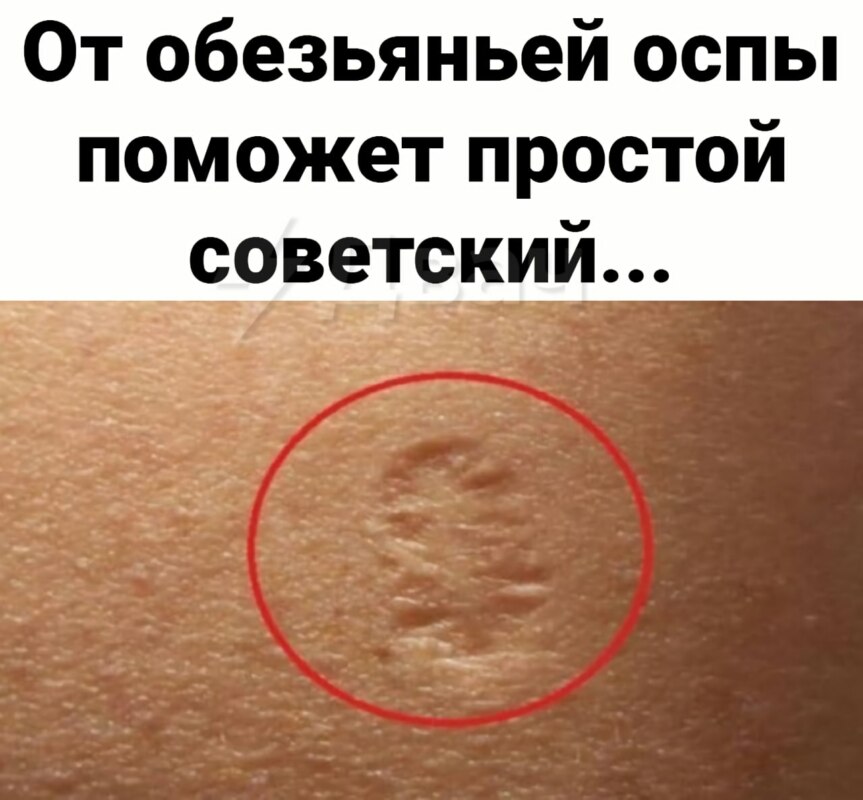 обезьянья оспа 2022